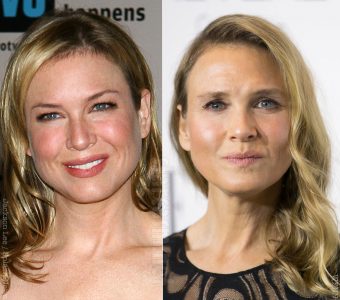 blepharoplastie renee zellweger