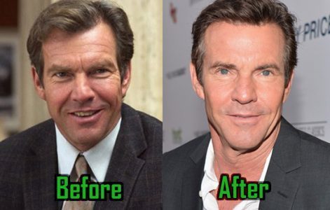 dennis_quaid_chirurgie_esthetique_visage