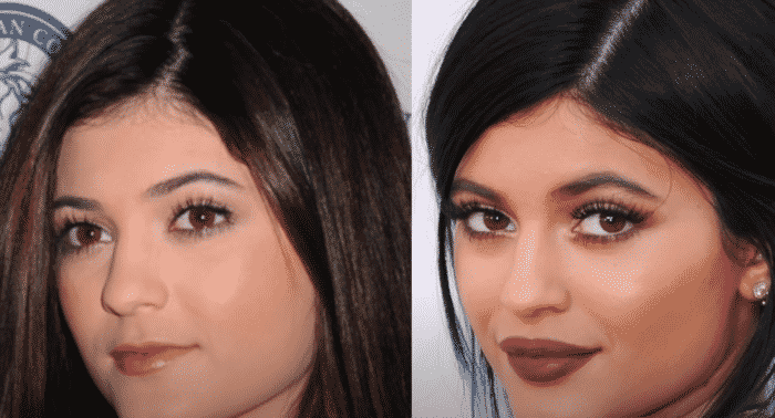 kylie jenner et la chirurgie eshtetique