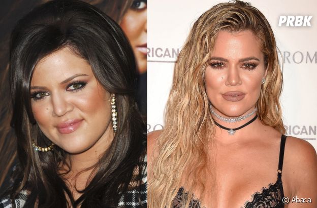 khloe-kardashian-chirurgie-esthétique