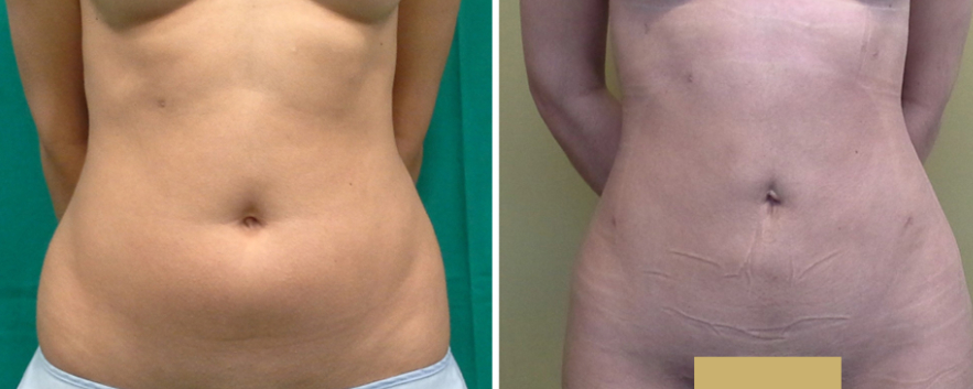 liposuccion abdominale résultat photos