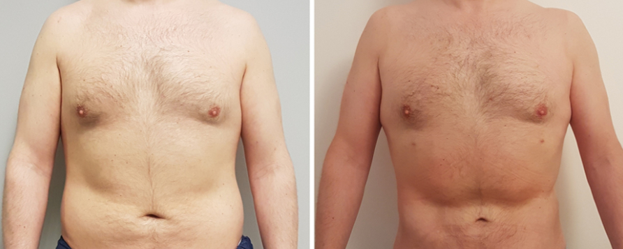 résultat liposuccion ventre homme